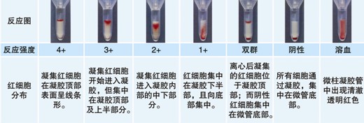 【試驗?zāi)康暮驮怼? ABO血型鑒定是通過檢測被檢者紅細(xì)胞上是否存在A和/或B抗原（正定型）以及被檢者血漿中是否存在抗A和/或抗B抗體（反定型）來確定。 對于成年個體被檢者，紅細(xì)胞上的A和/或B抗原與血漿中的抗A和/或抗B抗體存在一種對應(yīng)關(guān)系。其獨特性質(zhì)在于：紅細(xì)胞上缺乏A和/或B抗原，則血清中存在與所缺乏的抗原對應(yīng)的強(qiáng)反應(yīng)性抗體，如紅細(xì)胞上缺乏A抗原，則可以預(yù)見血漿中存在抗A抗體。 常規(guī)的ABO定型必須包括正定型（紅細(xì)胞定型）和反定型（血漿定型），并將正反定型結(jié)果相互驗證，如果紅細(xì)胞發(fā)生凝集，預(yù)期其凝集強(qiáng)度≥2+；只有正反定型結(jié)果一致時才能準(zhǔn)確定型。 20121212104627668.jpg  然而，有時ABO正定型和反定型會出現(xiàn)結(jié)果不一致現(xiàn)象，或陽性反應(yīng)強(qiáng)度弱于2+。引起正反定型結(jié)果不一致因素有： （一）正定型出現(xiàn)弱反應(yīng)或缺失抗原 1. A亞型、B亞型或AB亞型。 2. 白血病導(dǎo)致A或B抗原減弱。 3. 何杰金?。℉odgkin’s）有時會抑制抗原表達(dá)，與白血病類似。 4. 由于某種疾?。ㄈ绺骨话⒁认侔?dǎo)致血漿中存在大量的型物質(zhì)，中和抗A或抗B抗體，引起正定型為假陰性或弱陽性。需要將正定型的紅細(xì)胞用生理鹽水洗滌后再次定型可解決此問題。 5. 骨髓移植 6. 非ABO同型輸血 （二）正定型紅細(xì)胞上多余的抗原反應(yīng) 1. 自身凝集紅細(xì)胞、抗體致敏紅細(xì)胞導(dǎo)致。 2. 細(xì)胞未洗滌，血漿蛋白引起的假陽性反應(yīng)。 3. 細(xì)胞未洗滌，血漿中存在針對正定型試劑中某種成分的抗體導(dǎo)致。 4. 骨髓移植。 5. 獲得性B。 6. B（A）現(xiàn)象。 7. ABO非相合輸注。 （三）正定型出現(xiàn)混合視野反應(yīng) 1. 近期輸血。 2. 骨髓移植。 3. 異卵雙胞胎或雙受精卵產(chǎn)生的嵌合體。 4. 胎兒和母體出血。 5. A3亞型。 （四）反定型血清中出現(xiàn)弱反應(yīng)或反應(yīng)缺失 1. 年齡相關(guān)：新生兒以及小于6月齡的嬰兒以及老年人。 2. ABO亞型有亞型抗體，如A2、A2B型人的抗A1。 3. 低球蛋白血癥（如白血病人、使用免疫抑制劑患者、免疫缺陷患者）。 4. 移植患者使用抗排異藥物。 5. 雙胞胎或雙受精卵產(chǎn)生的嵌合體。 （五）反定型出現(xiàn)多余的抗體反應(yīng) 1. 冷自身抗體。 2. 特異性冷同種抗體。 3. 血清中存在針對試劑紅細(xì)胞保存液成分的抗體。 4. 某些疾病導(dǎo)致球蛋白水平增高（多發(fā)性骨髓瘤、巨球蛋白血癥、Hodgkin’s 淋巴瘤）引起緡錢狀凝集。 5. 輸用大分子血漿擴(kuò)容劑。 6. 非ABO同型的移植。 7. 靜脈注射免疫球蛋白。 （六）技術(shù)方面的錯誤 1. 血液樣本被污染，如混入其他人樣本。 2. 被檢紅細(xì)胞的濃度過高或過低。 3. 忘記在反應(yīng)體系中加入檢測樣本或試劑。 4. 未按照試劑使用說明進(jìn)行試驗。 5. 離心步驟離心時間不足或離心時間超時。 6. 對試驗結(jié)果記錄或判讀不正確。 為了解決ABO亞型引起的ABO正反定型不一致以及正定型紅細(xì)胞上抗原產(chǎn)生弱反應(yīng)或抗原反應(yīng)性缺失，可以使用ABO亞型定型卡來輔助血型鑒定。 ABO亞型定型卡系采用凝膠作為微柱凝膠卡的填充物，將生物化學(xué)的凝膠分子篩過濾技術(shù)、離心技術(shù)和血型血清學(xué)的抗體特異性結(jié)合在一起。每卡有八個凝膠管，其中抗A凝膠管灌注了含抗A抗體的凝膠；抗A1凝膠管灌注了含抗A1抗 體的凝膠；抗B凝膠管灌注了含抗B抗體的凝膠；抗AB凝膠管灌注了含抗AB抗體的凝膠；抗H凝膠管灌注了含抗H抗體的凝膠；A細(xì)胞、B細(xì)胞及Ctl管中灌 注了不含血型抗體的凝膠，A細(xì)胞、B細(xì)胞用于檢測血漿中的抗體，Ctl管用于自身對照。當(dāng)抗原抗體反應(yīng)時，凝集的紅細(xì)胞在離心力的作用下不能通過凝膠而留 在凝膠上層或游離在凝膠中，呈現(xiàn)陽性反應(yīng)；而抗原抗體沒有反應(yīng)時，未凝集的紅細(xì)胞在離心力的作用下可通過凝膠而沉積在微柱凝膠管的底部，呈現(xiàn)陰性反應(yīng)。 【ABO亞型定型卡的用途】 鑒定紅細(xì)胞上的ABO抗原，解決亞型引起ABO正反定型不一致、以及正定型紅細(xì)胞上抗原產(chǎn)生弱反應(yīng)或抗原反應(yīng)性缺失的問題。 【樣本要求】 1. 建議使用抗凝的血樣，尤其是EDTA抗凝管采集的血樣，需要量2ml。（EDTA抗凝采血管為紫帽管）。 2. 血液樣本在采集后48小時以內(nèi)檢測。 【所需儀器設(shè)備及耗材】 1. ABO亞型定型卡 2. 血型血清學(xué)離心機(jī)（用于離心分離血漿、洗滌紅細(xì)胞） 3. 微柱凝膠卡離心機(jī) 4. 微量移液槍及吸頭 【試驗操作】  一、被檢血液樣本的處理 1. EDTA抗凝的血液樣本離心3000rpm 1分鐘，將上清血漿轉(zhuǎn)入一支12×75mm試管中備用，得到壓積紅細(xì)胞。 2. 另取一支12×75mm試管中，加入0.1ml上述步驟1中的壓積紅細(xì)胞 ，用生理鹽水洗滌一次，棄上清，得到壓積紅細(xì)胞。 3. 在一支12×75mm 試管中，加入1ml生理鹽水（或LISS液），加入步驟2中得到的壓積紅細(xì)胞10μl，混勻得到0.8~1%的被檢紅細(xì)胞懸液。 二、 紅細(xì)胞定型 1. 取ABO亞型定型卡一片，注意檢查外觀，確保凝膠管的凝膠上層存在液面，凝膠不會干枯。將符合要求的卡進(jìn)行標(biāo)記，按照試驗需要撕開封口膜。 2. 用微量移液槍分別向每孔樣品槽中沿樣品槽內(nèi)壁呈45°角緩慢加入50μl 0.8~1%的被檢者紅細(xì)胞懸液。 3. 在臺面交替輕叩卡左下角和右下角，確保所加入的液體在卡的樣品槽中呈水平狀態(tài)，而不是偏向一側(cè)。 4. 將卡放入微柱凝膠卡離心機(jī)離心，LB-3000低速離心機(jī)第一檔離心900rpm 2分鐘，再1500rpm 3分鐘，判讀結(jié)果并記錄。 【結(jié)果判讀及解釋】 1. 反應(yīng)陰、陽性的判讀 20121212104658937.jpg 2. 陰陽性結(jié)果解釋 (1) 陽性結(jié)果：紅細(xì)胞浮在凝膠表面或膠中，為陽性反應(yīng)。 (2) 陰性結(jié)果：紅細(xì)胞全部沉于微柱凝膠的底部。 (3) 血型亞型鑒定需要根據(jù)正反定型結(jié)果來判定，結(jié)果判定可參考下表。 20121212104720212.jpg 注：mf=混合視野，w=弱反應(yīng)。 【注意事項】 1. 建議在使用凝膠卡前先離心再應(yīng)用。 2. 若凝膠卡封口開裂、孔中凝膠干涸或有氣泡，不可使用。 3. 撕開凝膠卡封口膜時，不能用力過猛，以免造成凝膠微孔間的交叉污染。 4. 樣本采集后應(yīng)盡快檢測，若試驗需要延遲，應(yīng)將樣本置2~8℃下短期儲存。 5. 紅細(xì)胞懸液的濃度為0.8~1%，濃度過高或過低會影響檢測結(jié)果。 6. 溶血、脂血、細(xì)菌污染等情況的標(biāo)本會影響檢測結(jié)果。 7. 血漿或血清標(biāo)本須充分離心去除纖維蛋白，否則會阻止紅細(xì)胞在微柱凝膠中的沉降，出現(xiàn)假陽性。 8. 在Ctl孔（自身陰性對照）結(jié)果為陽性時，試驗結(jié)果無效?？赡茉蚴怯捎诒粰z紅細(xì)胞已經(jīng)致敏IgM抗體導(dǎo)致自發(fā)凝集，此時可以用DTT將已經(jīng)致敏到紅細(xì)胞上的IgM抗體破壞后再行試驗。 9. 人源血液樣本存在潛在的傳染性，凝膠卡使用后按醫(yī)療生物垃圾處理。